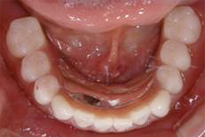 overdentures_03