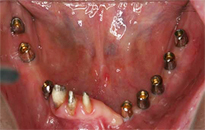 overdentures_04-2