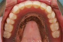 overdentures_05-1