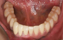 overdentures_05-2