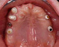 overdentures_06-1