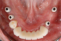 overdentures_06-2