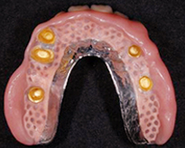 overdentures_07-1