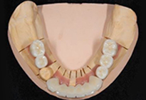 overdentures_07-2