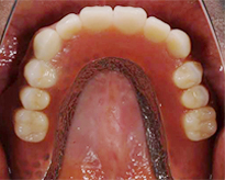 overdentures_08-1