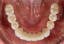 overdentures_08-2