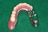 Partial Denture