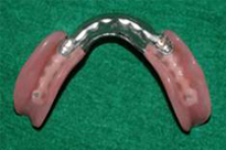 Vitallium Partials